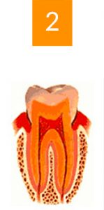 gingivite a avignon cabinet richard garrel soin de gencive et d implant dentaire a avingon dans le vaucluse