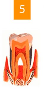 gingivite a avignon cabinet richard garrel soin de gencive et d implant dentaire a avingon dans le vaucluse