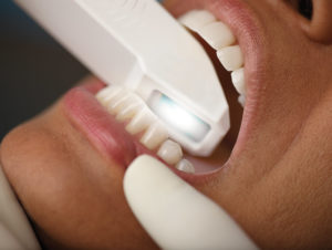 orthodontics-a-Avignon-in-the-surgeon-Vaucluse-implant-dental-richard-garrel-Invisalign-technical-revolutionary